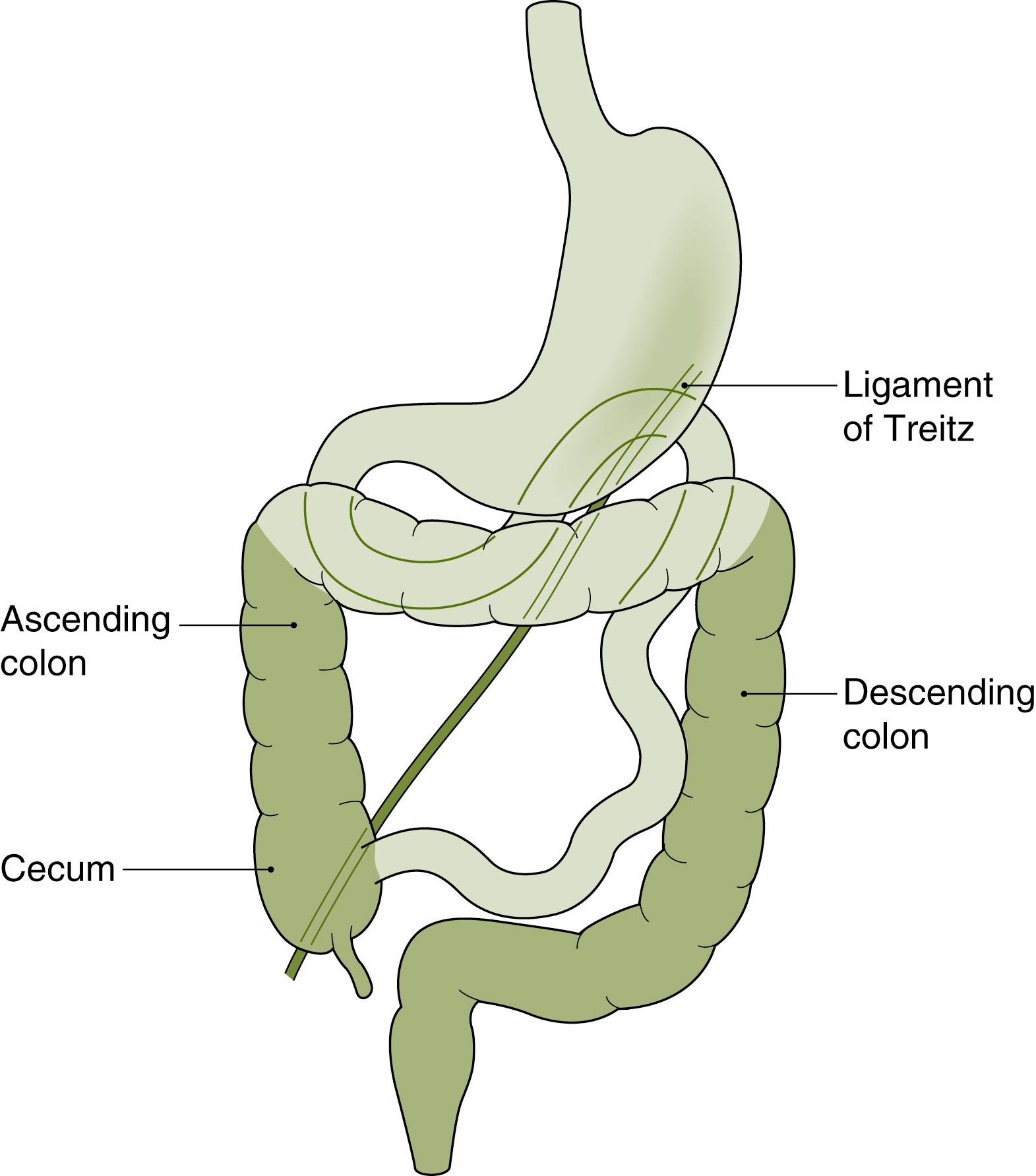 Fig. 56.2, Normal fixation of the midgut mesentery to the posterior body wall with the duodenojejunal segment at the ligament of Treitz and the cecum in the right lower quadrant. The shaded portions of the colon are extraperitoneal.