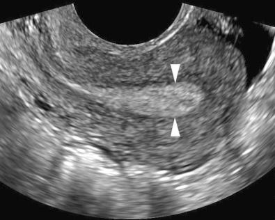 FIG 27-1, A 25-year-old woman referred for sonographic evaluation for oligomenorrhea. Longitudinal transvaginal sonographic image of the retroverted uterus shows a normal homogeneous endometrial echo complex measuring 8 mm in thickness. Standard measurement of the endometrium is performed at its thickest part ( arrowheads ) in the midsagittal plane.