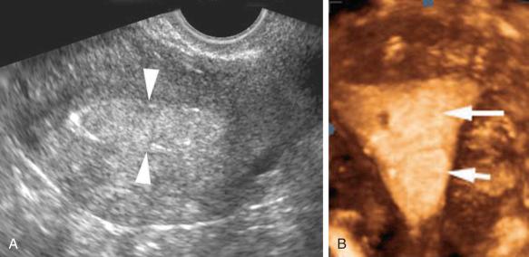 FIG 27-2, A 62-year-old woman with postmenopausal bleeding. A, Transvaginal sonography shows homogeneous echogenic thickening of the endometrial echo complex ( arrowheads ). B, Coronal three-dimensional image shows two subtle hyperechoic intracavitary masses ( arrows ). The additional information allowed triage to hysteroscopically guided biopsy and removal, confirming endometrial polyps.