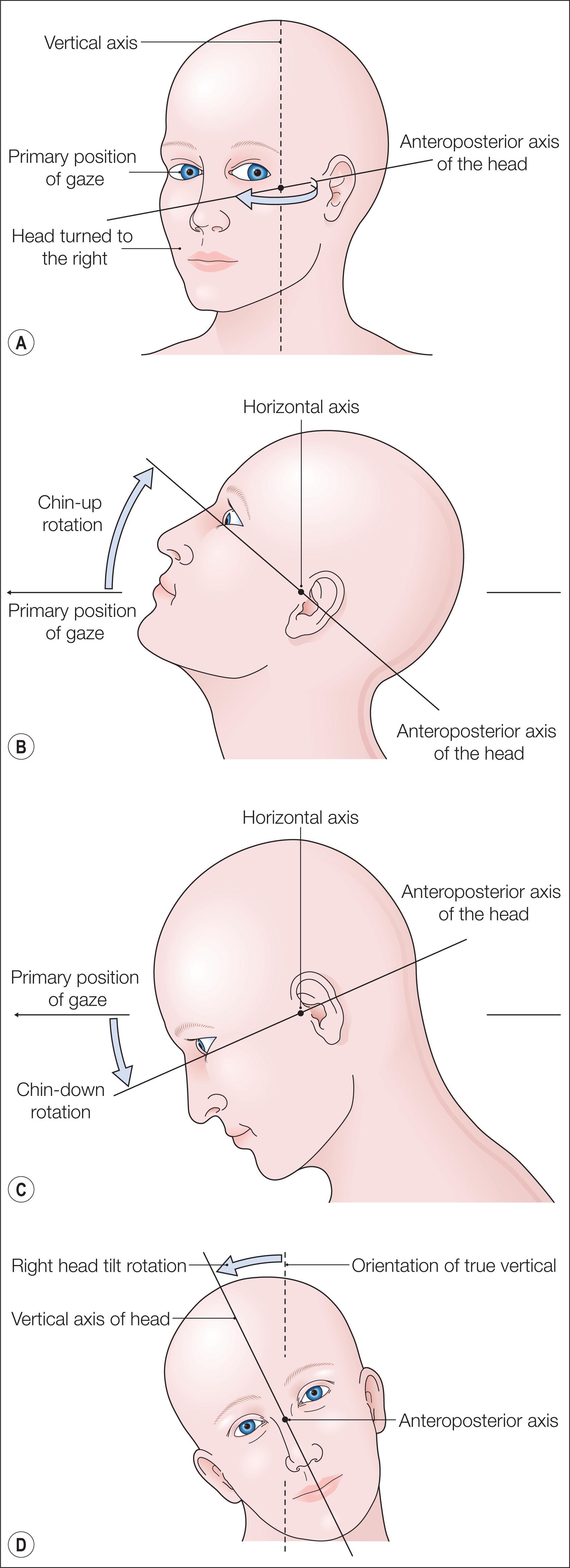 Fig. 102.1, Orientations of abnormal head postures. (A) Head turn to the right. The anteroposterior axis of the head is rotated from primary gaze direction to the right about the vertical axis. (B) Chin-up posture. The anteroposterior axis of the head is rotated upward from the primary gaze direction about the horizontal axis. (C) Chin-down posture. The anteroposterior axis of the head is rotated downward from the primary gaze direction about the horizontal axis. (D) Head tilt to the right shoulder. The vertical axis of the head is rotated away from the vertical axis about the anteroposterior axis.