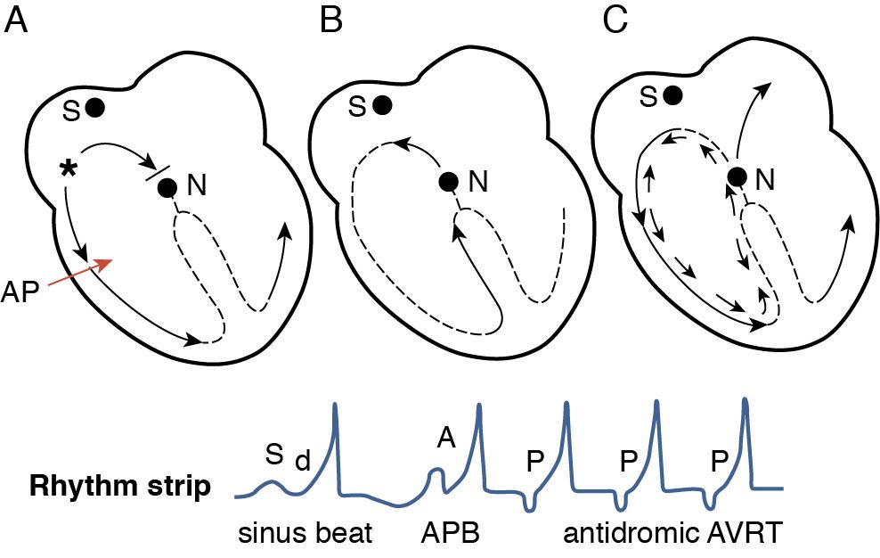 Fig. 8.4, The essential requirement for initiation of reentry excitation is a unilateral block that prevents uniform anterograde propagation of the initial cardiac impulse. Under appropriate conditions, this same cardiac impulse can traverse the area of blockade in a retrograde direction and become a reentrant cardiac impulse.