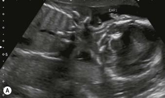 FIGURE 13-13, (A) A coronal scan through the ear and shoulder showing relationship of ear to head and shoulder – normal appearances.(Courtesy of Dr Anne Marie Coady.) (B) Coronal scan through the ear and shoulder showing relationship of ear to head and shoulder – low-set ears.