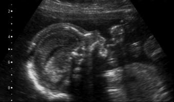 FIGURE 13-14, Sagittal scan of the fetal face demonstrating mild micrognathia, a break in the normal smooth curve running from forehead to nose to maxilla and mandible.