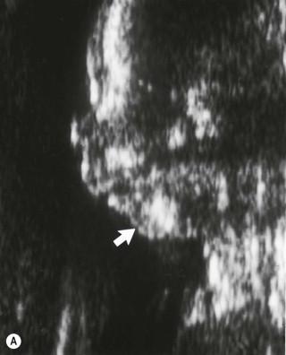 FIGURE 13-16, (A) Micrognathia – sagittal scan through a fetus with trisomy 18 showing micrognathia (arrow points to hypoplastic mandible). (B) Micrognathia – Severe micrognathia which was associated with a bent femur in this fetus.