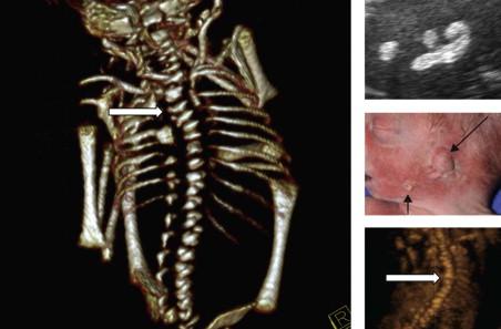 FIGURE 13-18, Goldenhar syndrome: hemivertebrae and scoliosis (block arrows), small deformed ears and pre-auricular tags and micrognathia (line arrows).