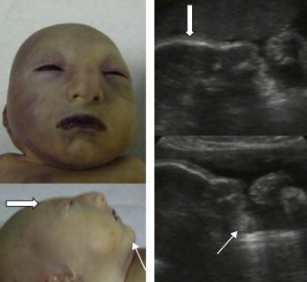 FIGURE 13-19, Seckel syndrome. Profile view showing severe micrognathia (line arrows) and small sloping forehead secondary to microcephaly (block arrow).