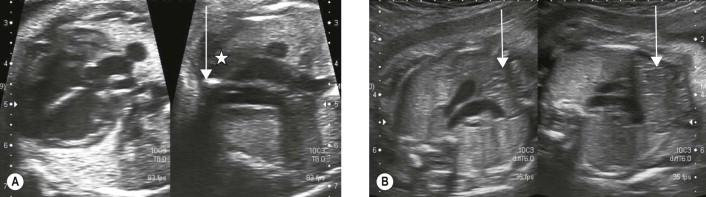 FIGURE 13-20, (A) Absent thymus: there is no intervening thymic tissue (asterisk) between the great vessels in the mediastinum and the bone of the sternum (arrow) in a fetus with Fallot's tetralogy (ventriculoseptal defect and aortic overlap). Karyotype confirmed as del22q11. Compare with normal thymus. (B) Normal intervening thymic tissue between the great vessels in the mediastinum and the bone of the sternum (arrow).