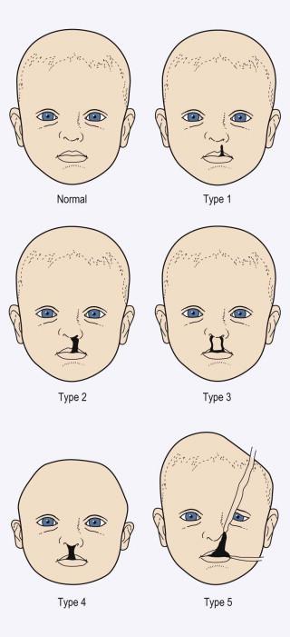 FIGURE 13-22, Ultrasound classification of facial clefts.