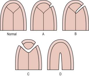 FIGURE 13-23, Facial clefting. The four common types of facial clefting. (A) Unilateral cleft lip. (B) Unilateral cleft lip and palate. (C) Bilateral cleft lip and palate. (D) Isolated cleft palate.