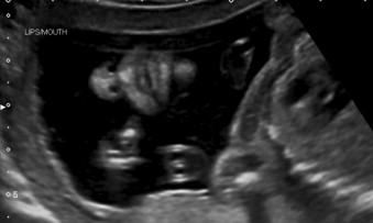 FIGURE 13-5, Coronal scan through the lips showing the nostrils, lips and chin.