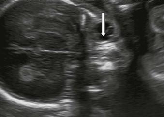 FIGURE 13-6, Transverse scan through the orbit showing the lens of the eye and the hyaloid artery (arrow).