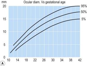 FIGURE 13-7, Graphs of orbital measurements. (A) Ocular diameter vs. gestational age. (B) Interocular distance vs. gestational age.