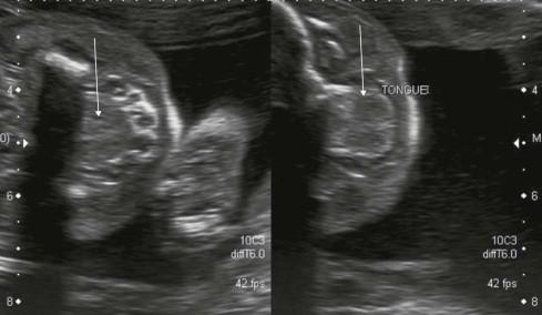 FIGURE 13-10, Transverse scan through the mouth showing the fetal tongue (arrows).