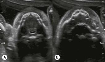 FIGURE 13-8, Transverse scan through the mandible (A) and the maxilla (B) showing tooth buds.