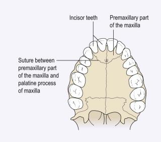 FIGURE 13-9, The human palate in the axial plane showing the suture between the primary and secondary palate.