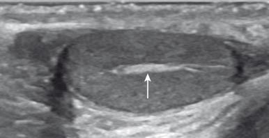 Figure 125.3, Mediastinum testis.