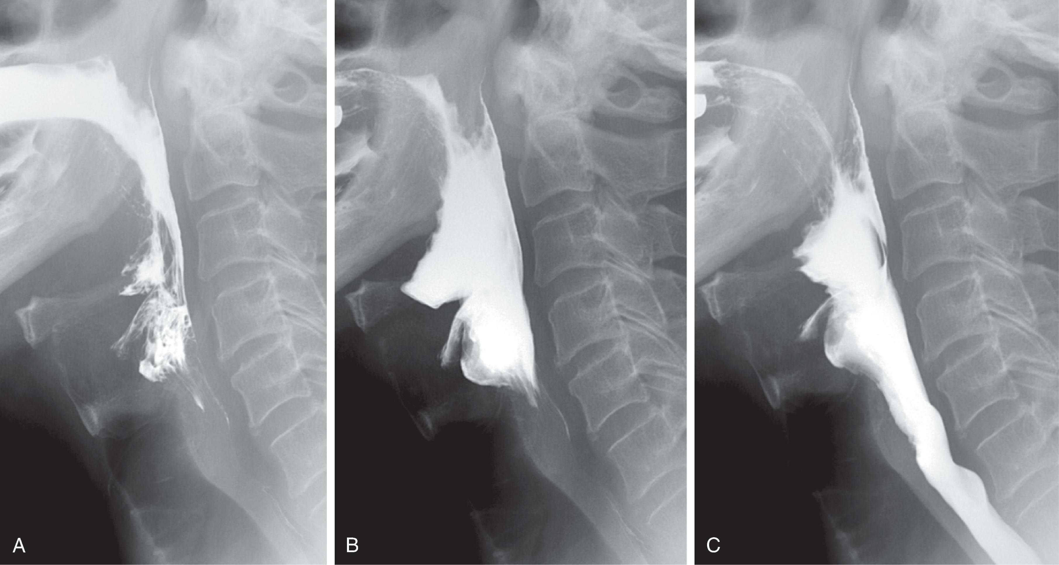 Fig. 5.1, Laryngeal penetration due to mediastinal tumor invading the recurrent laryngeal nerves. (A) Image obtained just as barium enters the oropharynx shows the hyoid bone starting to rise. Thyrohyoid apposition has occurred. (B) The bolus is now in the oropharynx and hypopharynx. Despite near complete hyoid elevation and thyrohyoid apposition, the laryngeal vestibule has not yet closed, allowing a moderate amount of barium to enter the vestibule. (C) The last portion of the bolus is now in the hypopharynx and cervical esophagus. The laryngeal vestibule is now partly closing (though late), forcing some penetrated barium back into the hypopharynx. The epiglottis has barely tilted. Lack of epiglottic tilt and delayed/poor closure of the laryngeal vestibule despite normal hyoid elevation pulling on the hyoepiglottic ligament and normal thyrohyoid apposition suggests a problem with the epiglottis and thyroarytenoid muscles. As there was no known cause for epiglottic stiffness (radiation therapy, gastroesophageal reflux, or tumor) or dysfunction (myopathy), the patient could have an abnormal recurrent laryngeal nerve supplying the laryngeal musculature. Subsequent computed tomography revealed an unsuspected lung cancer invading the mediastinum and encasing the recurrent laryngeal nerves.