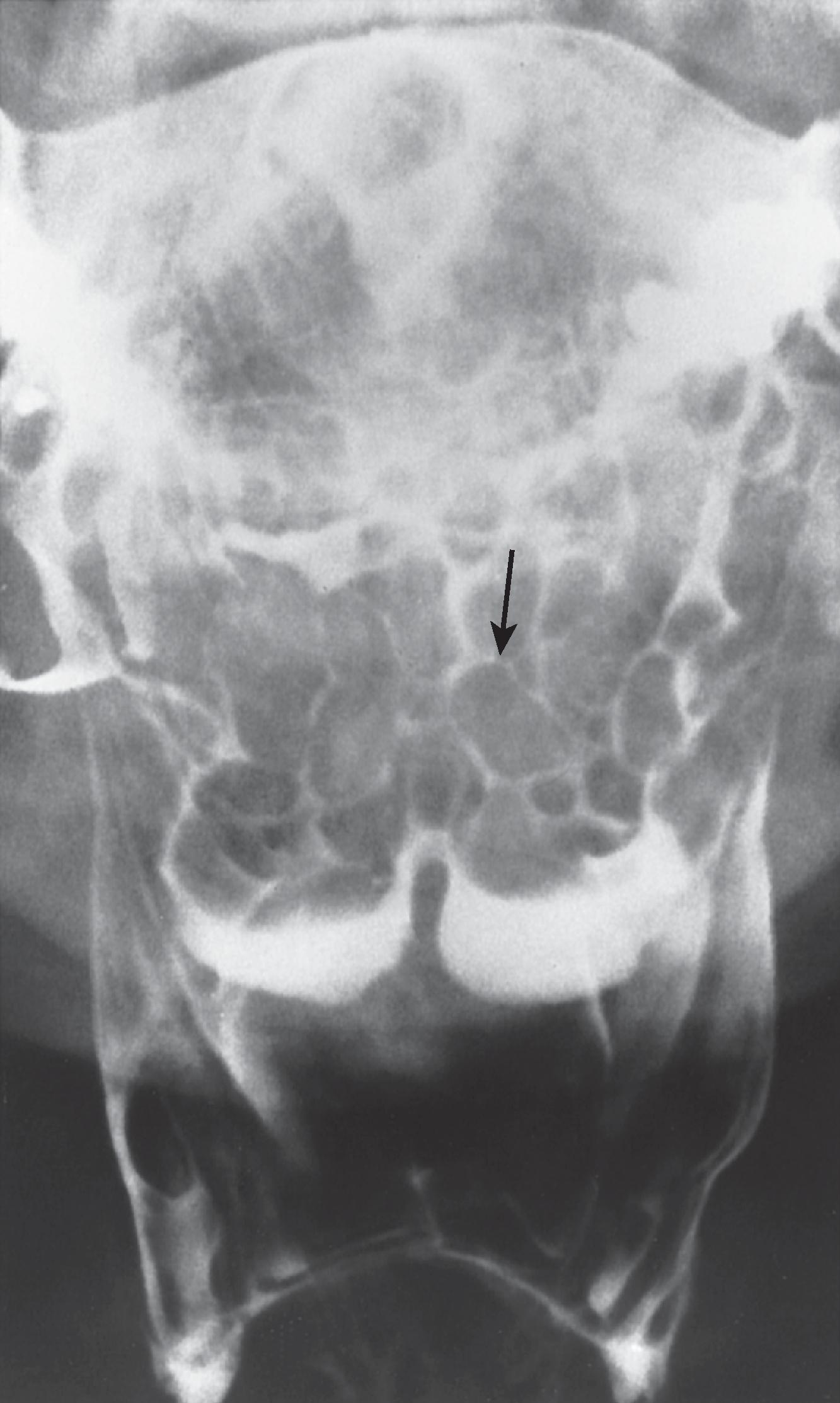 Fig. 5.11, Lymphoid hyperplasia of the base of the tongue. Frontal view of the pharynx shows large, smooth-surfaced, round to ovoid nodules ( arrow ) symmetrically distributed over the surface of the tongue base.