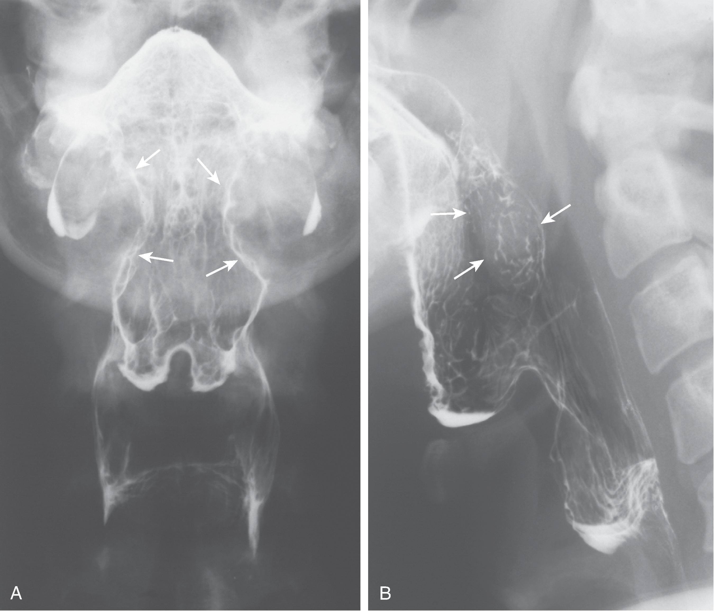 Fig. 5.12, Lymphoid hyperplasia of the palatine tonsils. (A) Frontal and (B) lateral views of the pharynx show symmetrically enlarged palatine tonsils bilaterally ( arrows ).