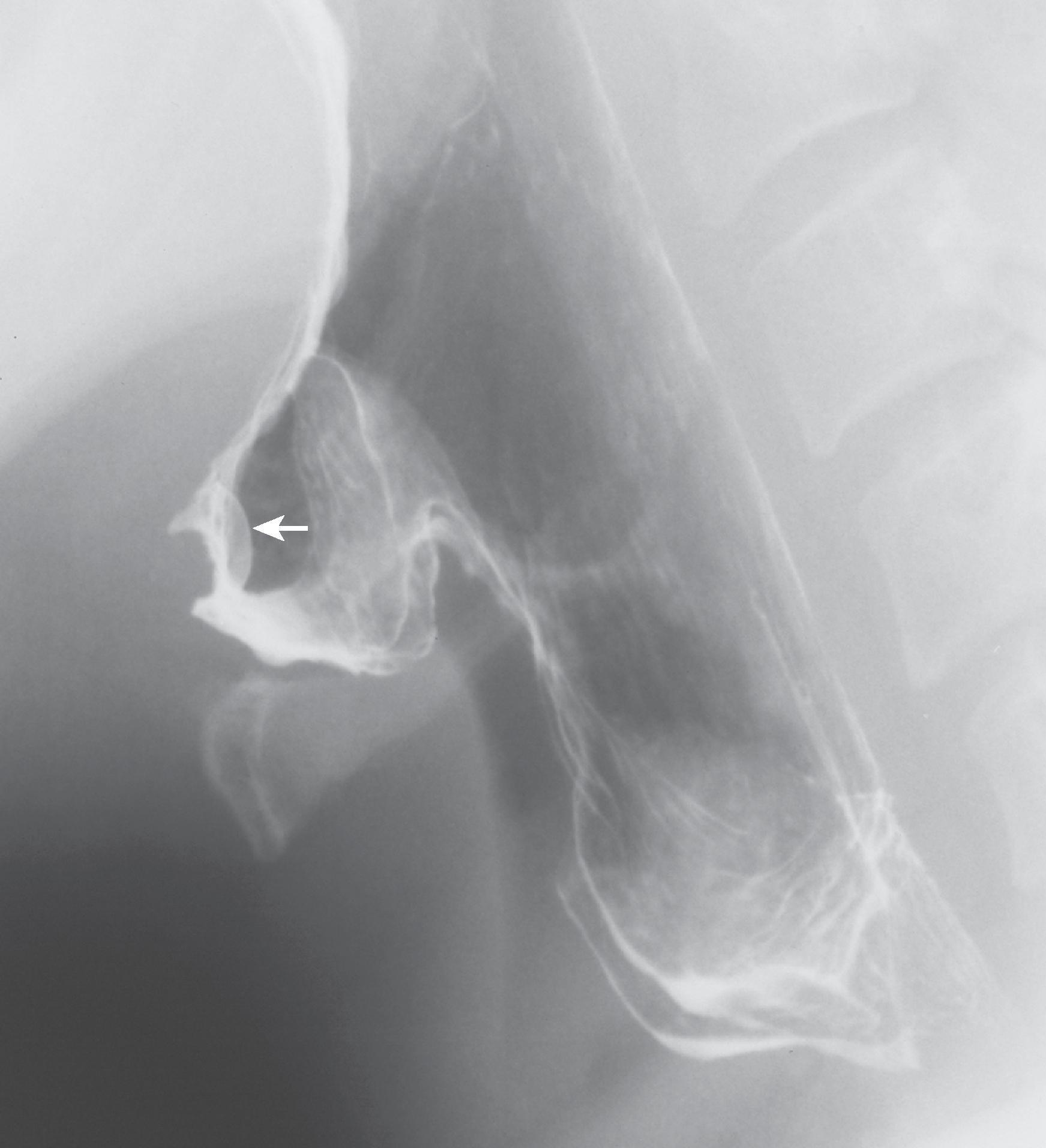 Fig. 5.13, Retention cyst at the base of the tongue. Lateral view of the pharynx shows a smooth-surfaced hemispheric mass ( arrow ) protruding from the posteroinferior tongue base.