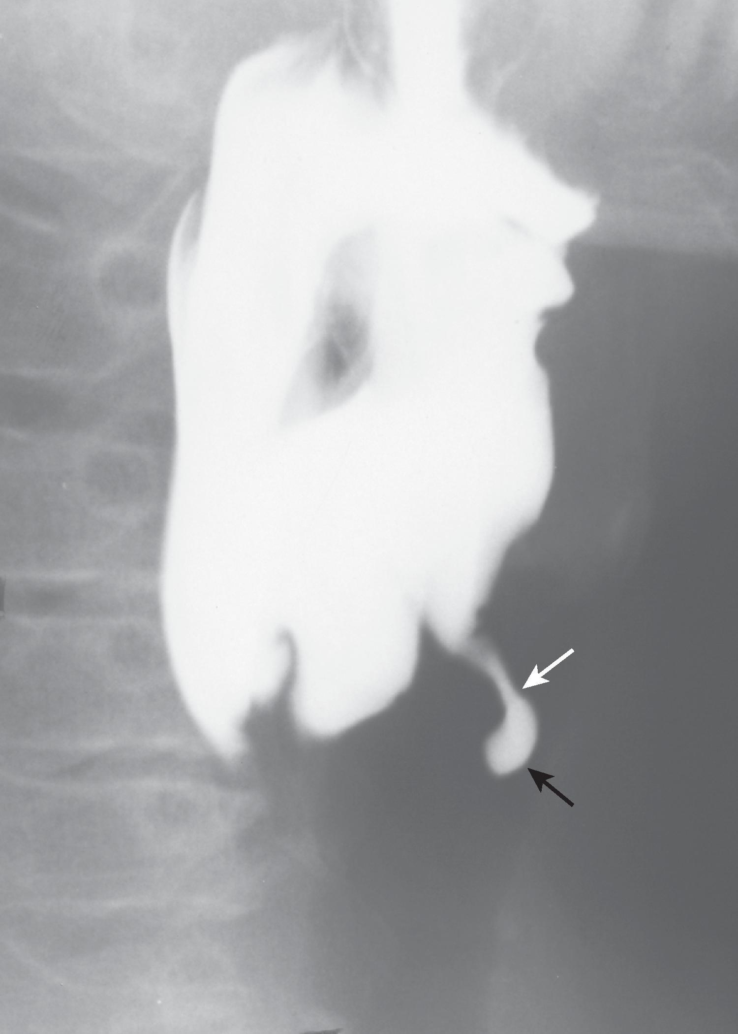 Fig. 5.4, Fourth branchial pouch sinus. Left posterior oblique view of the pharynx shows a thin, 1.5-cm long, barium-filled track ( white arrow ) arising from the anterolateral wall of the lower left piriform sinus. The track has a saccular configuration at its blind tip ( black arrow ).