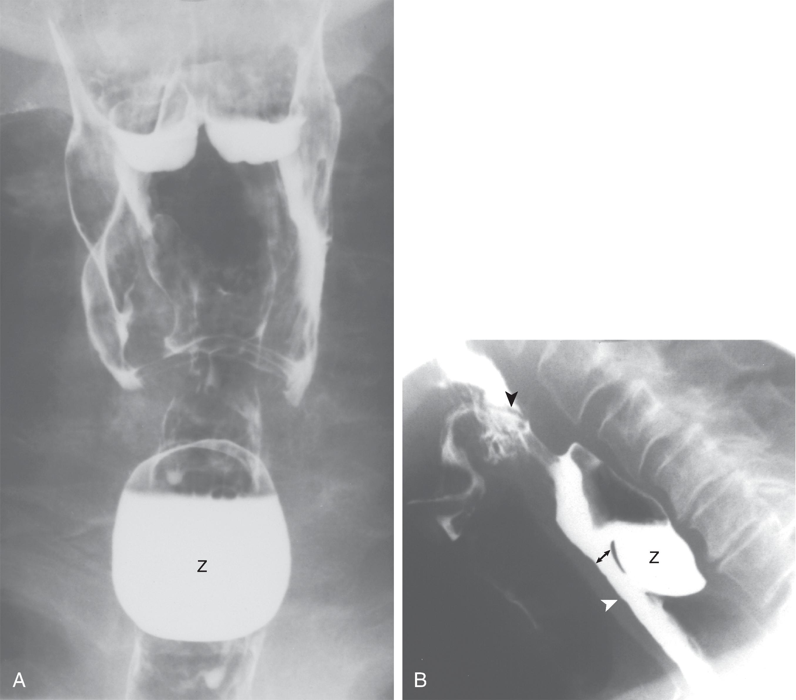 Fig. 5.5, Zenker’s diverticulum. (A) Frontal view of the pharynx shows a 3- × 4-cm barium-filled sac ( Z ) in the midline below the inferior tips of the piriform sinuses. Barium also coats the vocal cords because of abnormal epiglottic tilt. (B) Lateral view during swallowing shows Zenker’s diverticulum as a barium-filled sac ( Z ) posterior to the cervical esophagus ( white arrowhead ). The opening of the sac is superior to the posterior wall of the pharyngoesophageal segment ( double arrow ). The pharyngoesophageal segment is mildly narrowed. Also note diminished epiglottic tilt ( black arrowhead ) and laryngeal penetration.