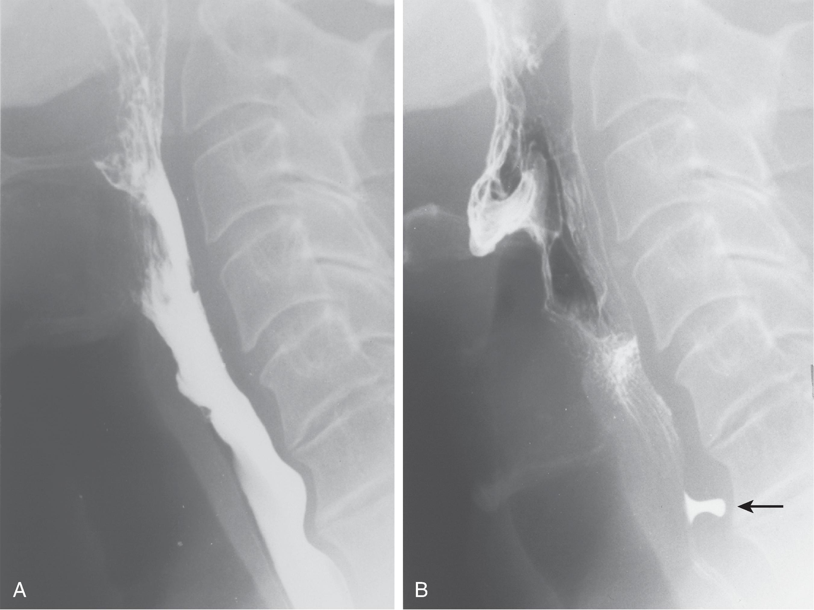 Fig. 5.6, Pseudo-Zenker’s diverticulum. (A) Lateral view of the pharynx during swallowing shows no evidence of a posterior pouch as the bolus passes through the pharyngoesophageal segment. (B) A repeat view just after swallowing shows transient trapping of barium ( arrow ) above an early-closing cricopharyngeal bar that could be mistaken for a tiny Zenker’s diverticulum.