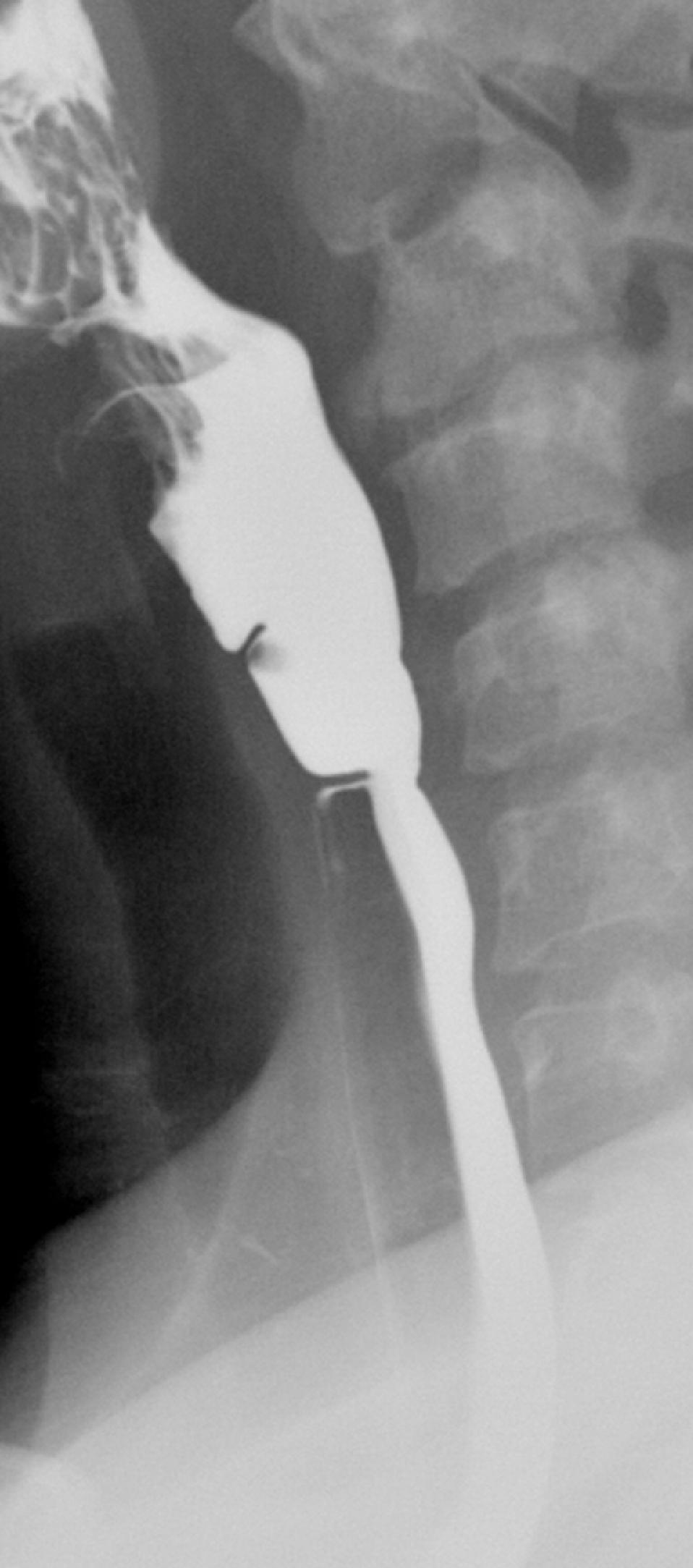 Fig. 5.8, Cervical esophageal webs with partial obstruction. Lateral view of the neck shows two cervical esophageal webs. The lower, tighter web is obstructive and produces a jet phenomenon, with a column of barium spurting through the narrowed segment and mild dilation of the proximal cervical esophagus. Note poor coating of the anterior esophageal wall below the web because of this jet phenomenon.