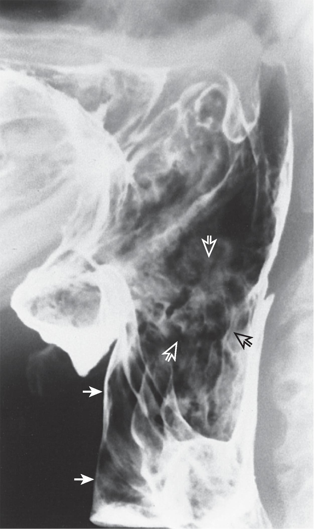 Fig. 5.9, Candida pharyngitis. Lateral view of the pharynx shows well-circumscribed plaques ( open arrows ) at the level of the epiglottis. Note laryngeal vestibule penetration ( solid arrows ) resulting from abnormal pharyngeal motility associated with this inflammatory pharyngitis. (From Rubesin SE. Pharynx. In: Laufer I, Levine MS, eds. Double Contrast Gastrointestinal Radiology , 2nd ed. Philadelphia: WB Saunders; 1992.)