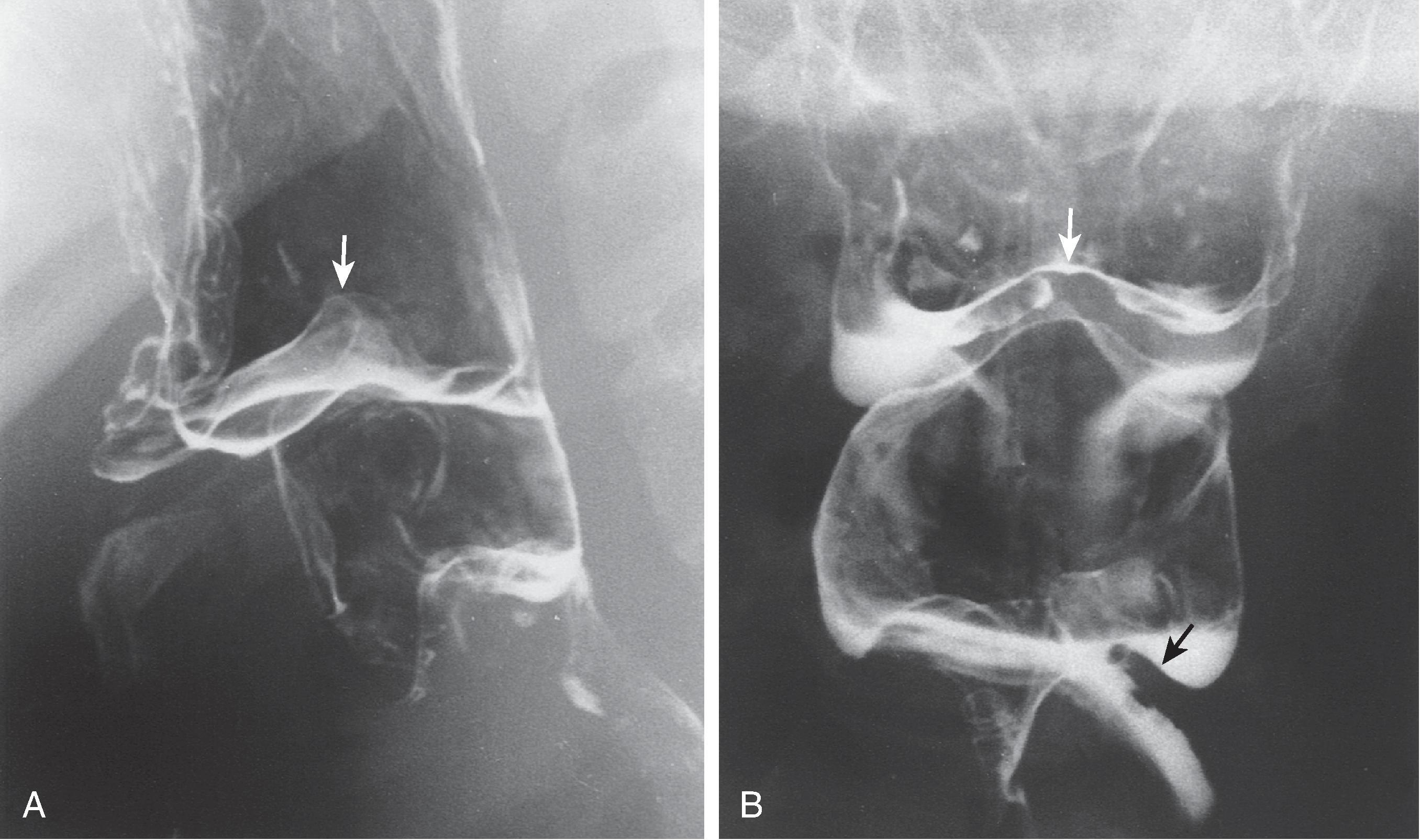 Fig. 5.10, Scarring caused by lye ingestion. (A) Lateral view of the pharynx shows truncation of the epiglottic tip ( arrow ). (B) Frontal view shows the epiglottis ( white arrow ) located inferior to its normal position. A scar is seen in the inferior portion of the left piriform sinus as a projecting fold of tissue ( black arrow ).