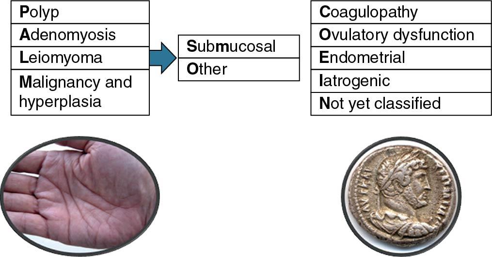 Fig. 26.1, PALM-COEIN Classification System for Abnormal Uterine Bleeding. The basic system comprises four categories that are defined by visually objective structural criteria (PALM), four that are unrelated to structural anomalies (COEI), and one reserved for entities that are not yet classified (N). The leiomyoma category is subdivided into patients with at least one submucosal myoma (L SM ) and those with myomas that do not affect the endometrial cavity (L 0 ). PALM-COEIN, polyp, adenomyosis, leiomyoma, malignancy and hyperplasia, coagulopathy, ovulatory dysfunction, endometrial, iatrogenic, and not yet classified.