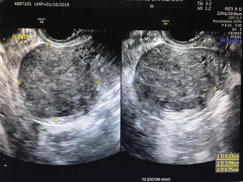 Fig. 26.2, Transvaginal sonography of uterus with adenomyosis: heterogeneous and hypoechogenic, area in the fundal myometrium with characteristic anechoic lacunae, and ill-defined borders, sagittal view ( A ) and coronal and axial views ( B ).
