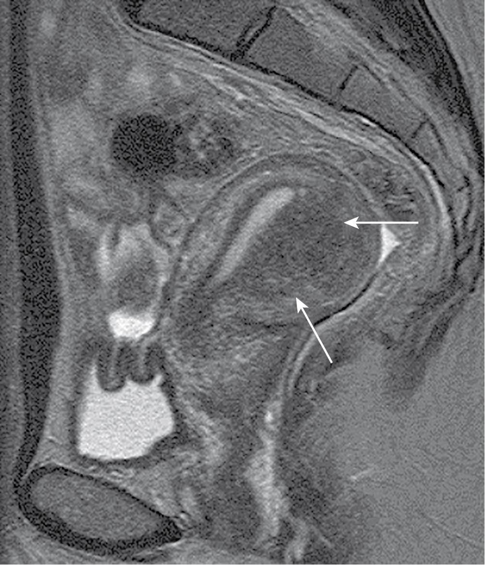 Fig. 26.3, Magnetic resonance image of asymmetric adenomyosis, as indicated by arrows .