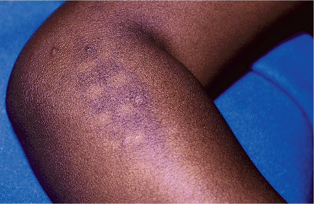 Fig. 26.11, Iron burn. This hyperpigmented patch is studded with evenly spaced, normally pigmented regions that correlate with sites of steam vent openings.