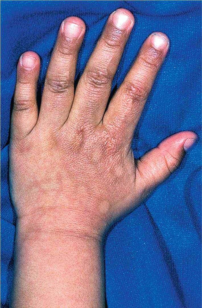 Fig. 26.12, Iron burn. This child’s hand reveals the classic hyperpigmentation with evenly spaced macules of sparing that occur at sites of steam vent openings.