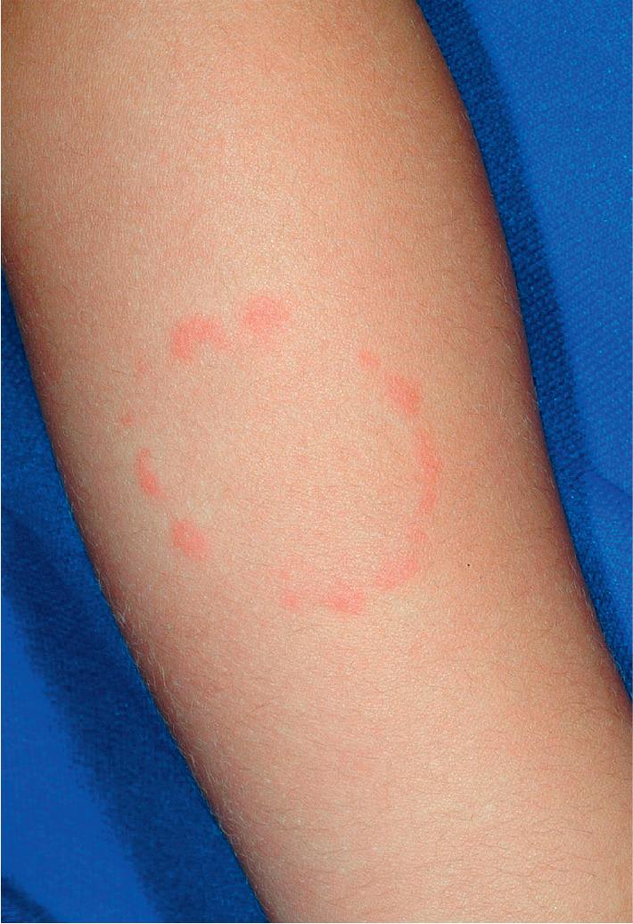 Fig. 26.15, Bite marks. These erythematous, petechial macules and papules revealed a dental arch width of 2.5 cm, more consistent with a child’s bite. There were no other clinical features of (or concerns for) child abuse in this 2-year-old girl.