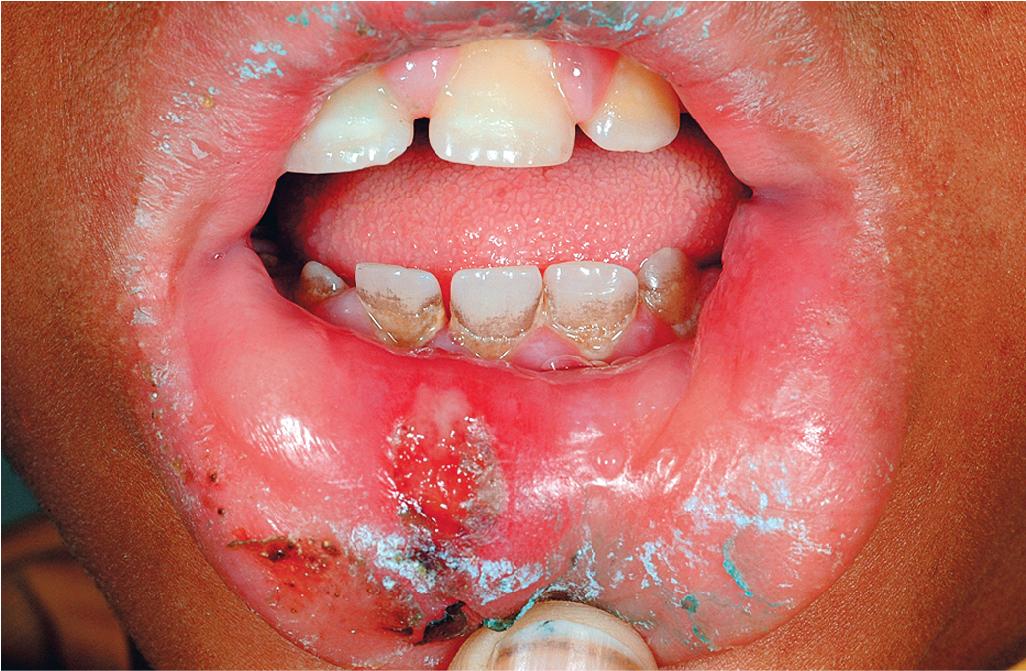 Fig. 26.17, Neglect. Dental neglect in this young boy presented as dental caries, periodontal disease, and aphthous ulcerations of the labial surfaces. This lesion was also culture-positive for herpes simplex virus.