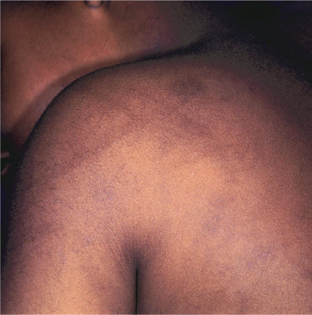 Fig. 26.3, Child abuse. These multiple overlapping, linear, and hyperpigmented patches were the result of postinflammatory changes at sites of whipping.