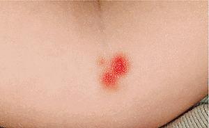 Fig. 26.5, Child abuse. Adjacent ecchymotic macules are typical of pinch marks.