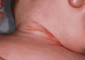 Fig. 26.6, Child abuse. These petechial linear abrasions were believed to be the result of a strangulation attempt in a child who had numerous other skin manifestations of abuse.