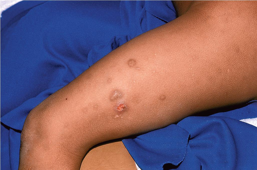 Fig. 26.9, Cigarette burns. This patient has evidence of fresh lesions (erythematous, eroded plaque) and older lesions in the forms of hyperpigmentation and scars.