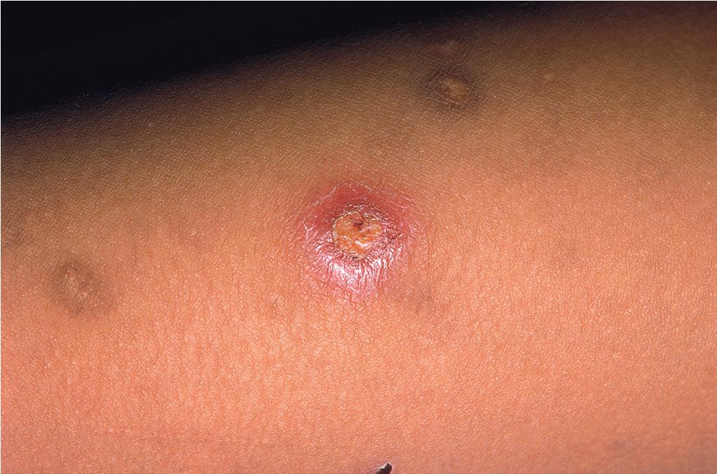 Fig. 26.10, Cigarette burns. These burns demonstrate the classic abuse finding of lesions in various stages of healing.