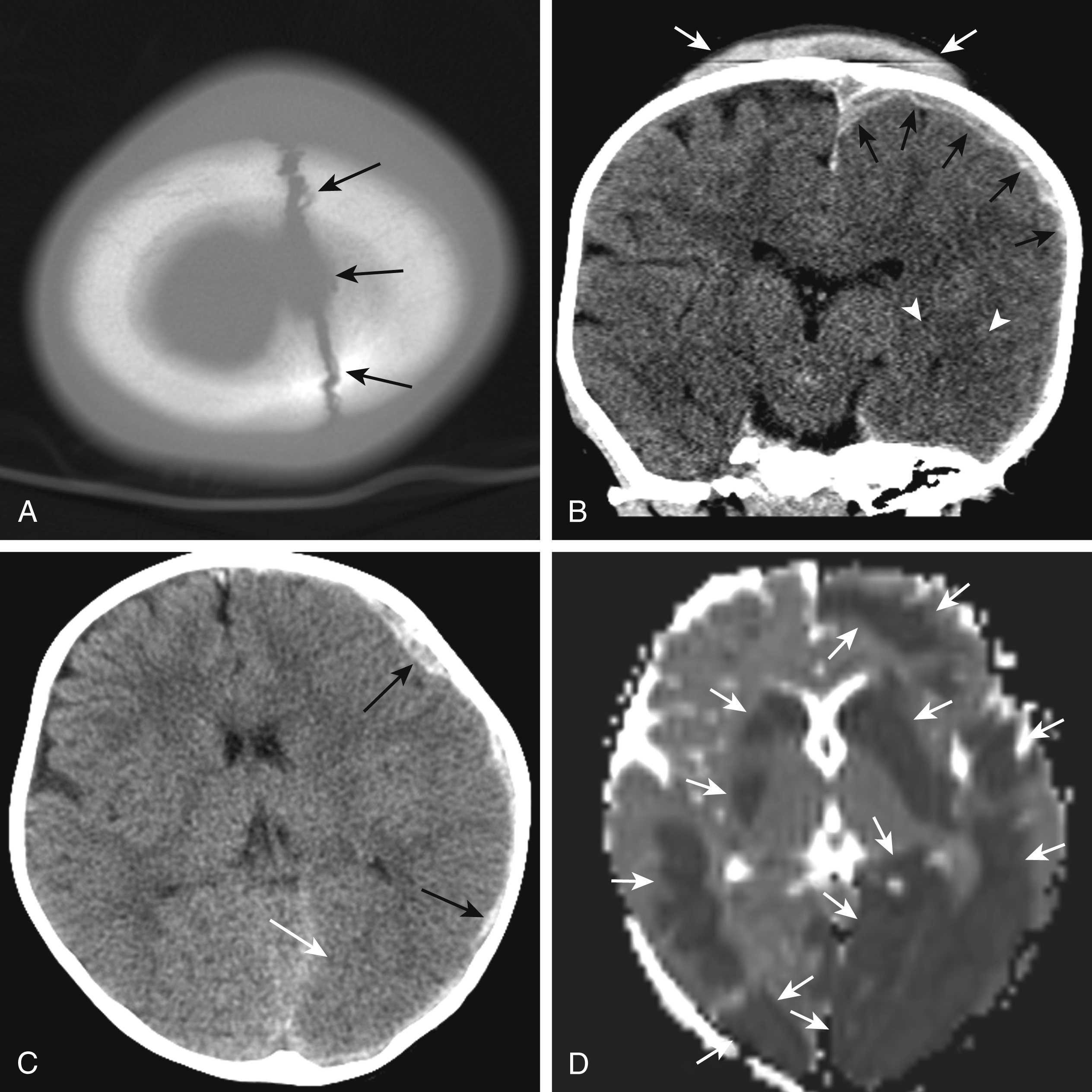 Fig. 20.1, Abusive head trauma (AHT).