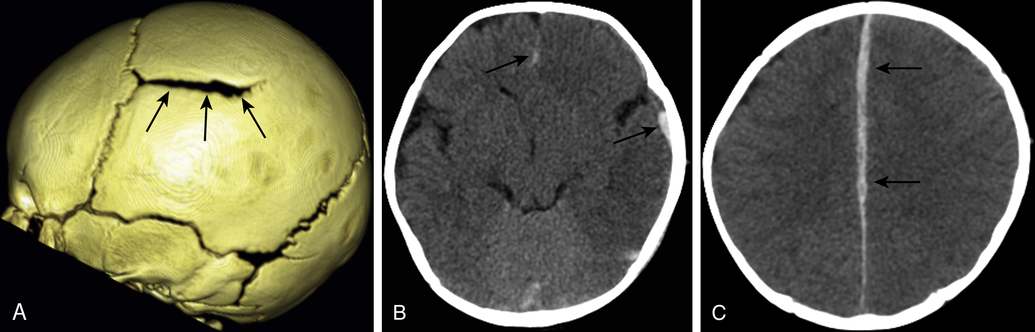 Fig. 20.3, Skull fracture in a child with abusive head trauma.