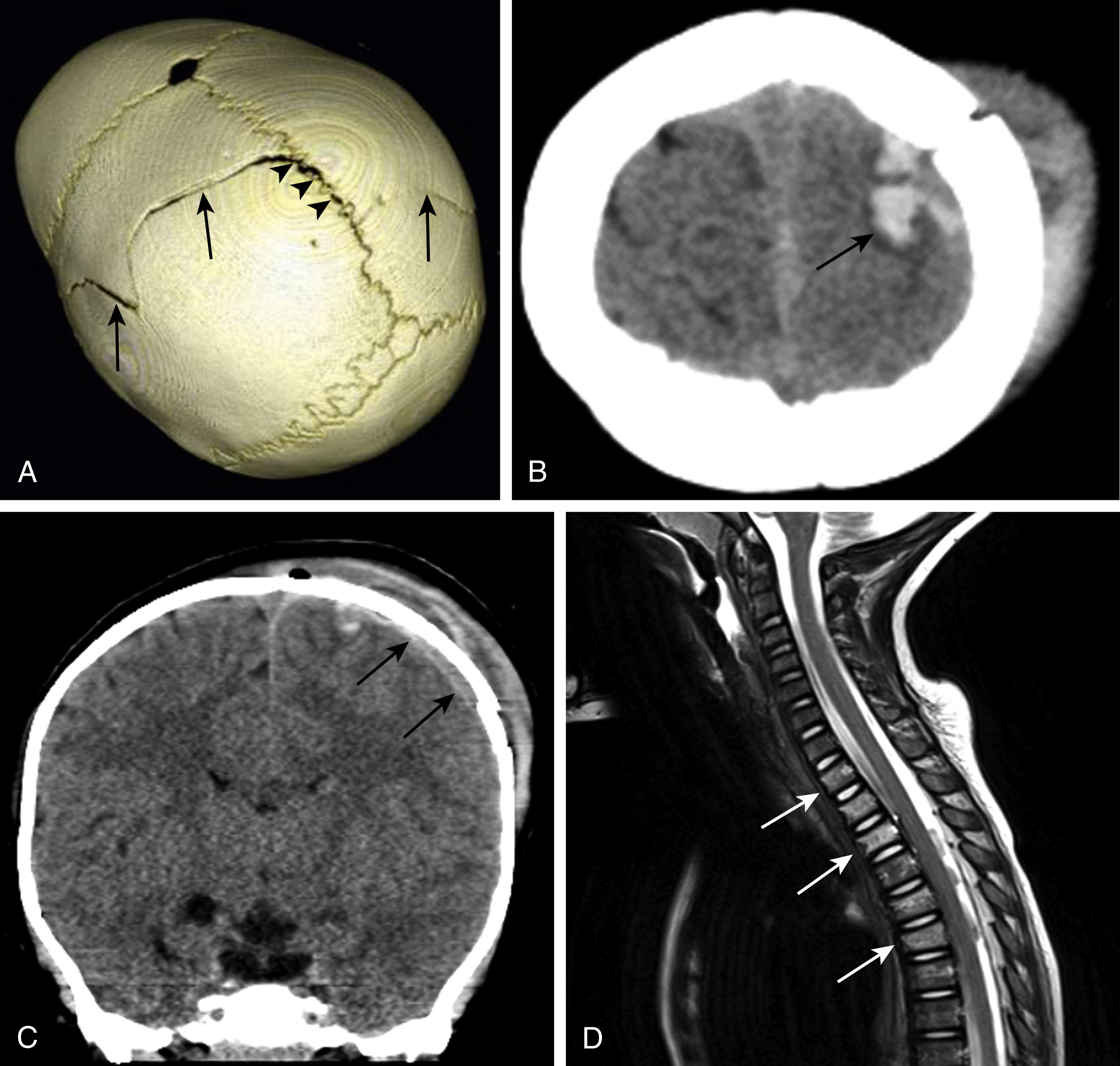 Fig. 20.4, Skull fracture.