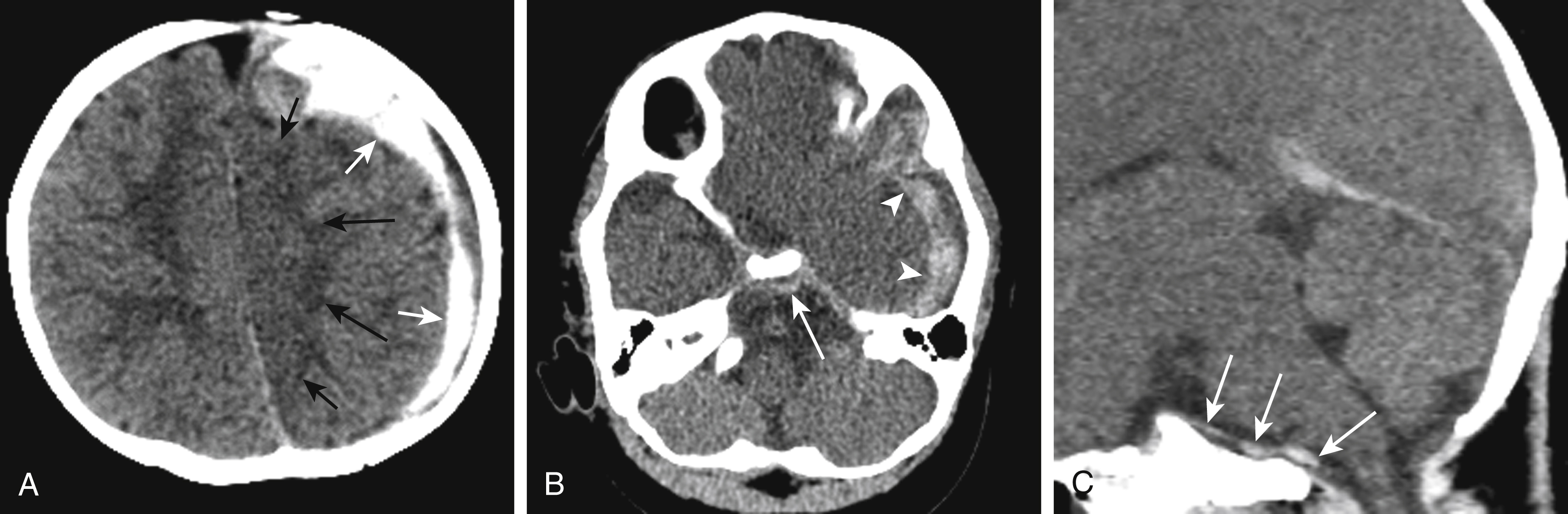 Fig. 20.5, Mixed-density subdural hematoma (SDH) from an avulsed bridging vein.