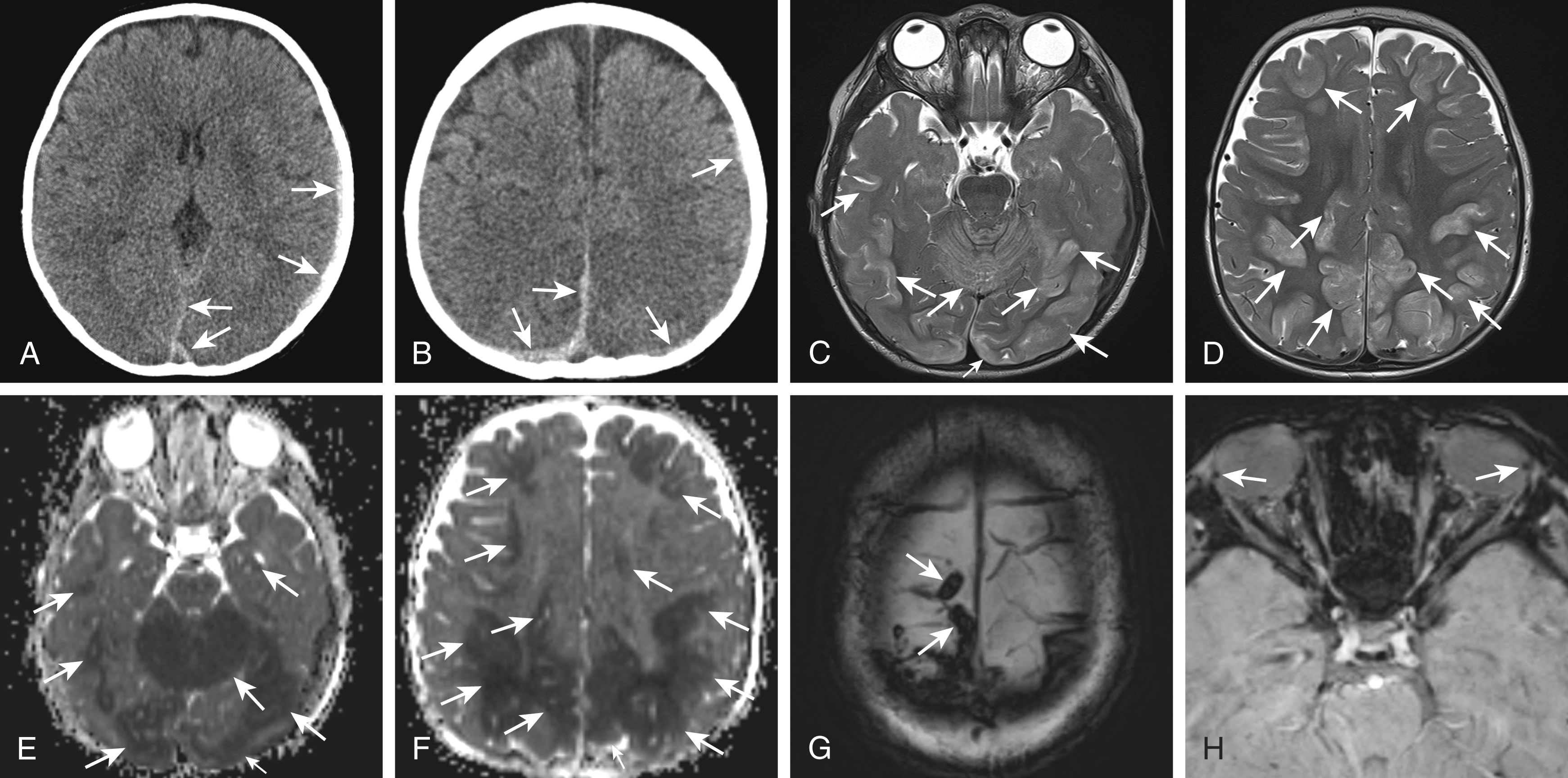 Fig. 20.6, Hypoxic ischemic injury (HII) and injured bridging veins.