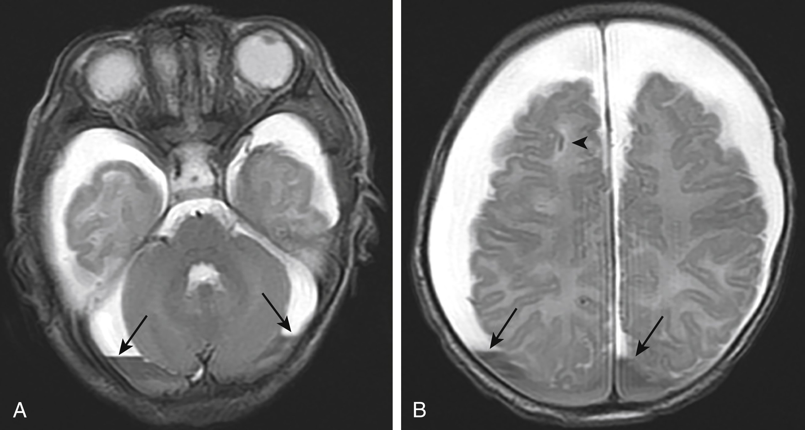 Fig. 20.7, Subdural hematomas (SDHs) with fluid–fluid levels.