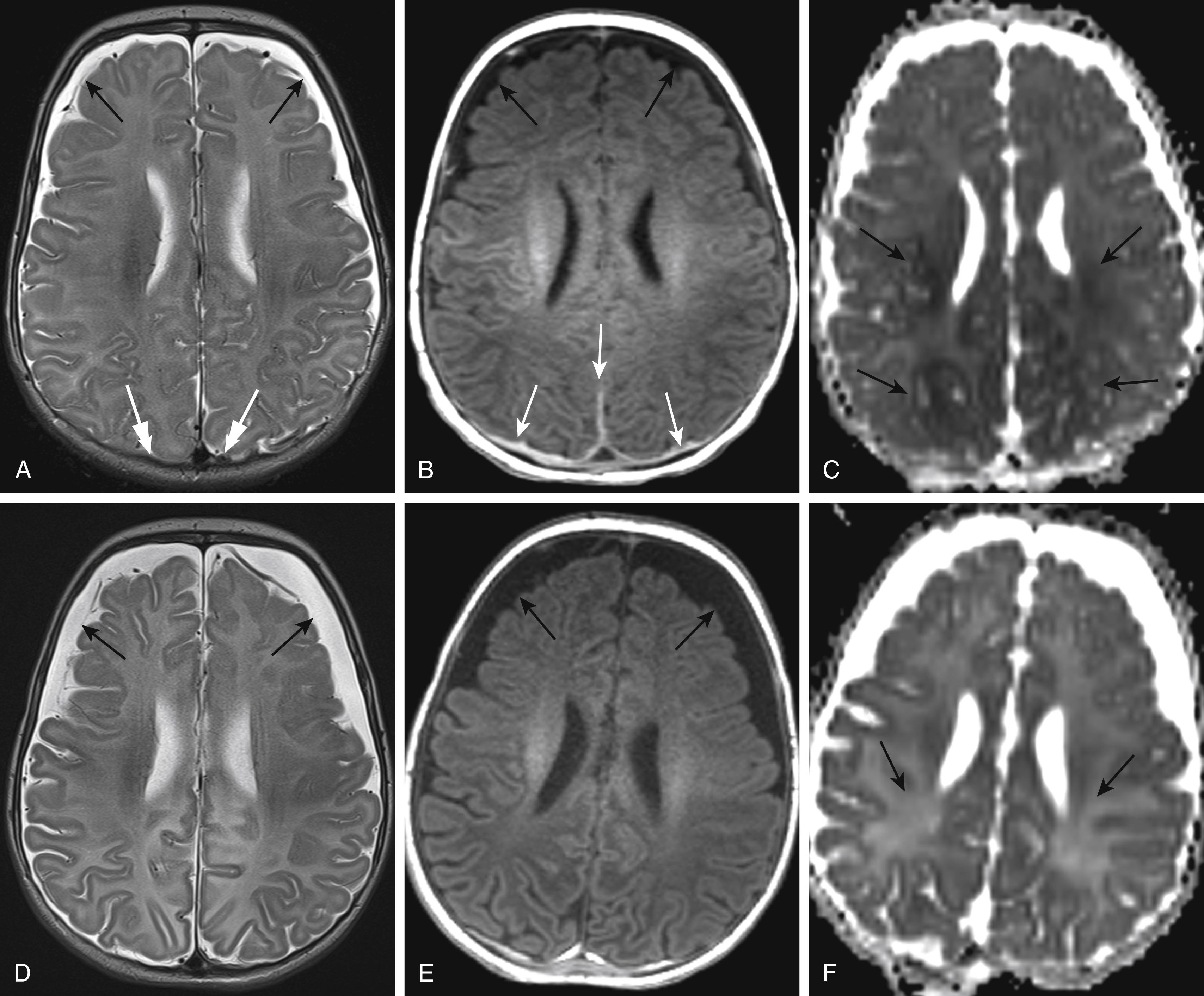 Fig. 20.9, Subdural hematohygromas.