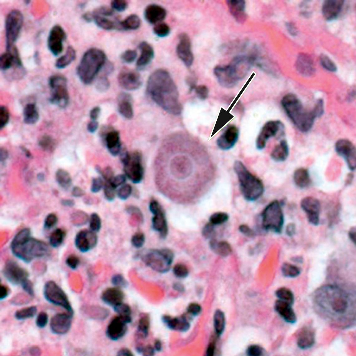 FIGURE 270.2, Acanthamoeba trophozoite (arrow) in a tissue biopsy (hematoxylin and eosin stain; original magnification, ×1000).